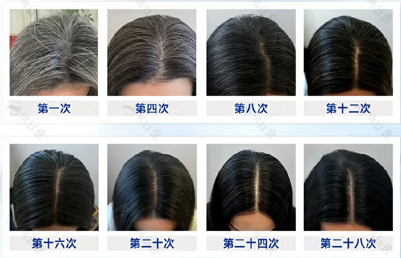 乌丝逸实体院白发养护28次案例1