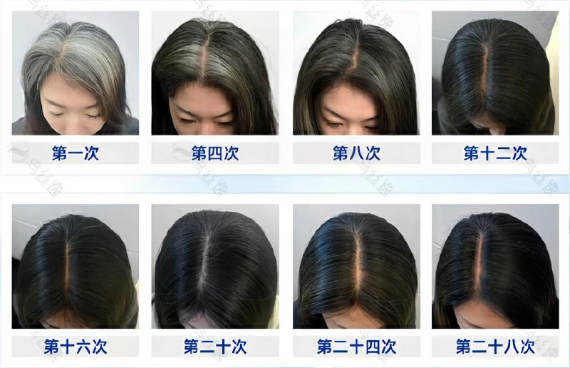 乌丝逸实体院白发养护28次案例案例2