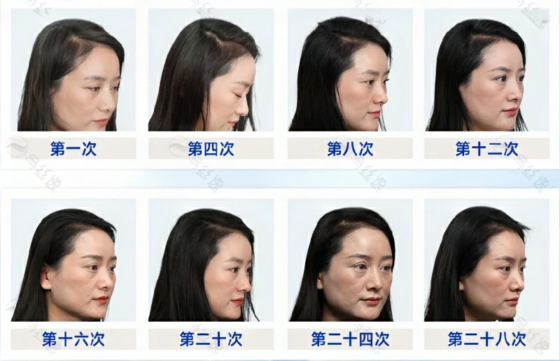 乌丝逸实体院白发养护28次案例案例3