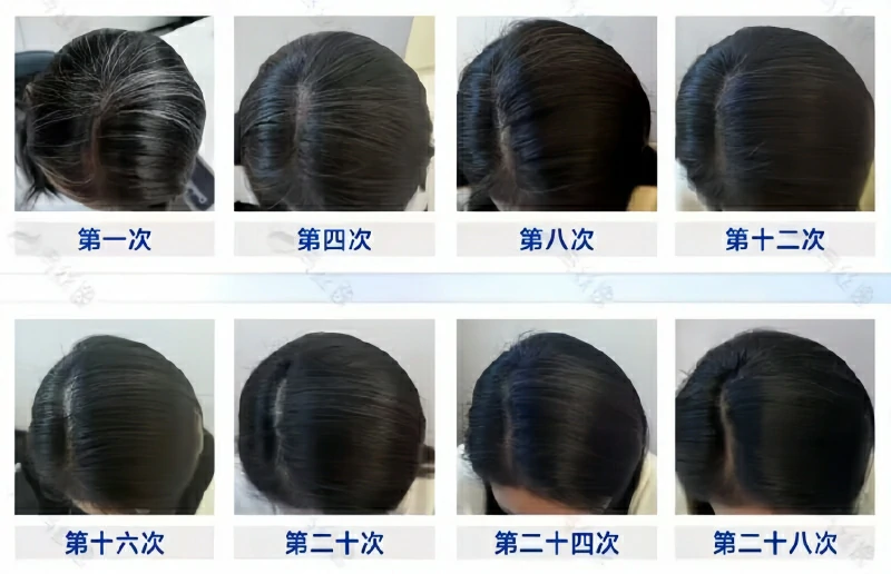 乌丝逸实体院白发养护28次案例案例4